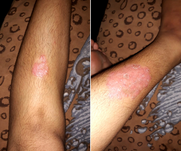 This Is How Psoriasis Changed This 23YO Girl's Perspective Towards Life!