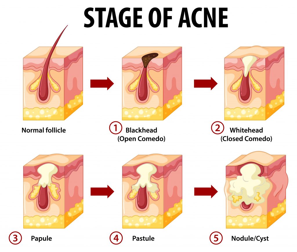 Stages of skin acne anatomy