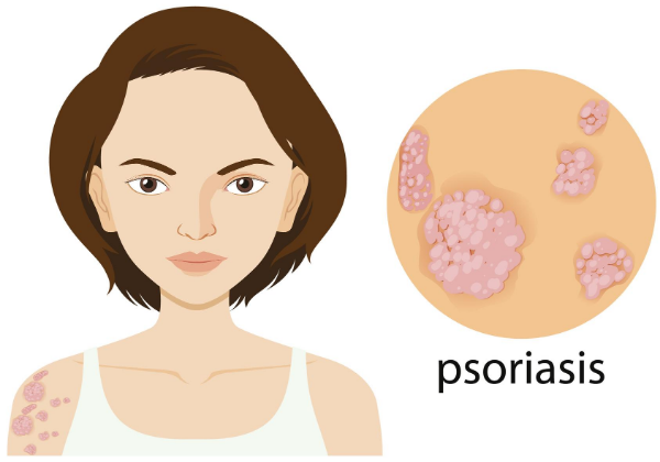 This Is How Psoriasis Changed This 23YO Girl's Perspective Towards Life! (5)