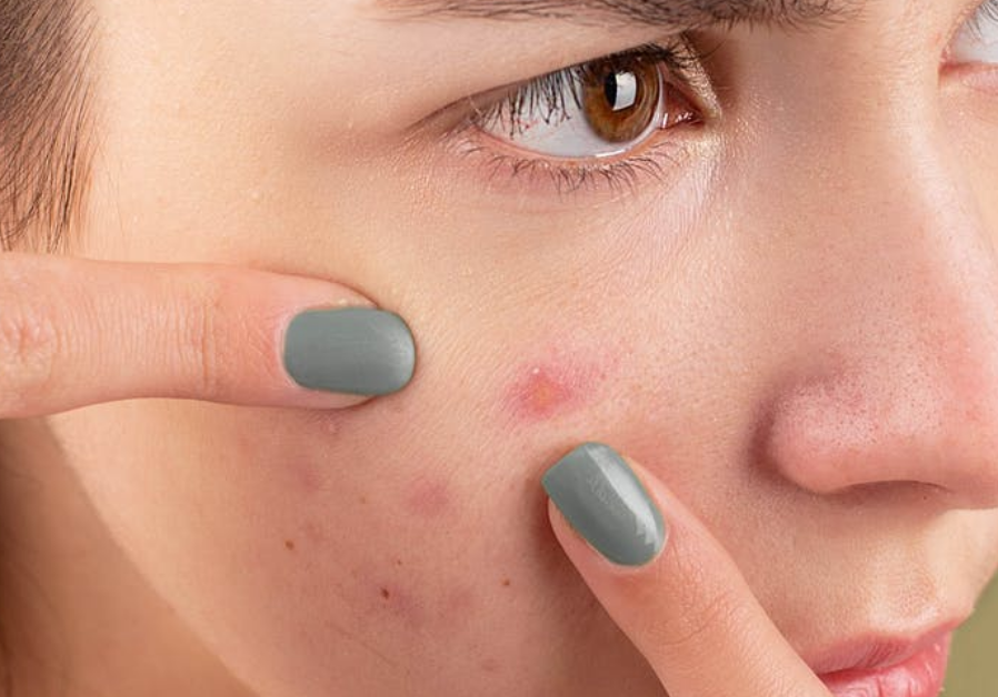 how to ace your battle with hormonal acne