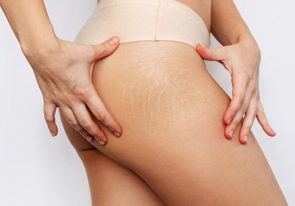 Loving & Normalising Stretch Marks: One Mark At A Time!